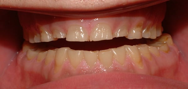 digrignamento-dei-denti